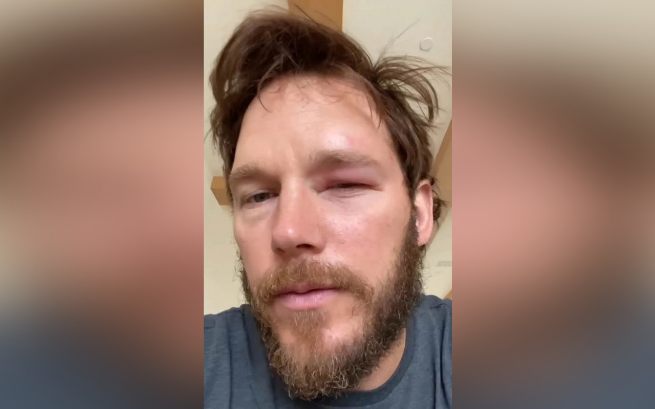Chris Pratt Shows His Swollen Eye After Getting Stung by Bee