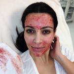 Kim Kardashian Gets Painful 'Vampire' Facial to Stay Young