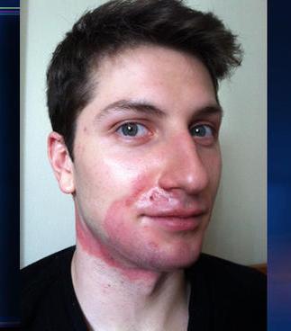 Severely-Burned Opera Actor Wesley Daniel to Return to Work as Understudy