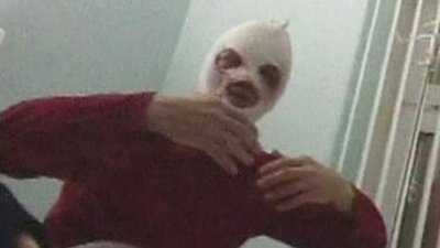 Bolshoi Ballet Art Director, Sergei Filin, Attacked With Acid by Masked Assailant