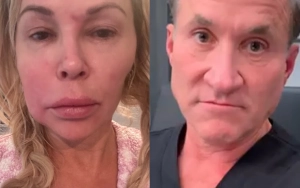 Brandi Glanville's Swollen Face May Take One Year to Treat, Says Dr. Terry Dubrow