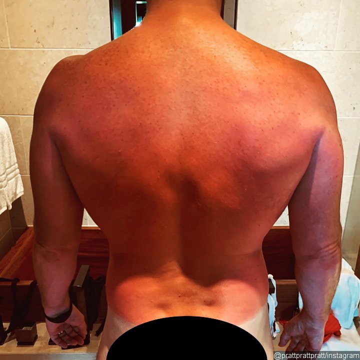 Chris Pratt Shows Off His Butt in Sunburn Photo