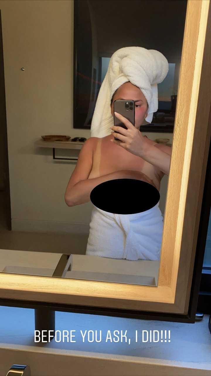 Chrissy Teigen Shows Her Sunburn