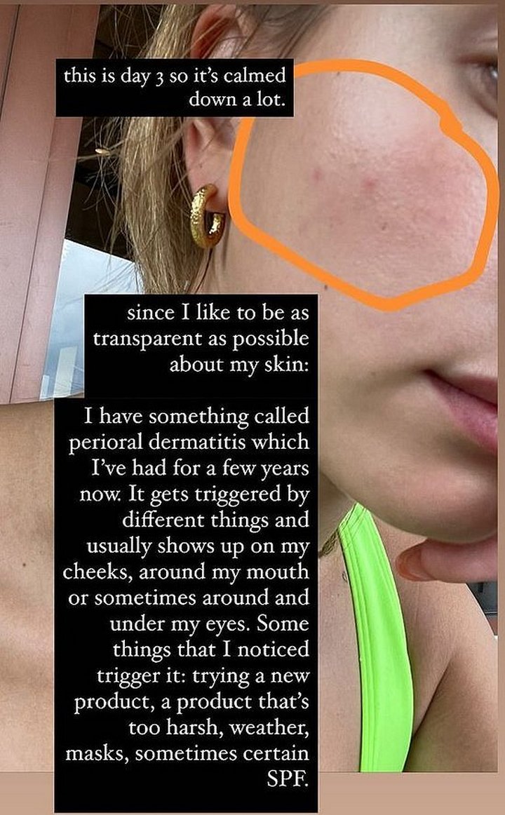 Hailey Baldwin goes public with skin battle