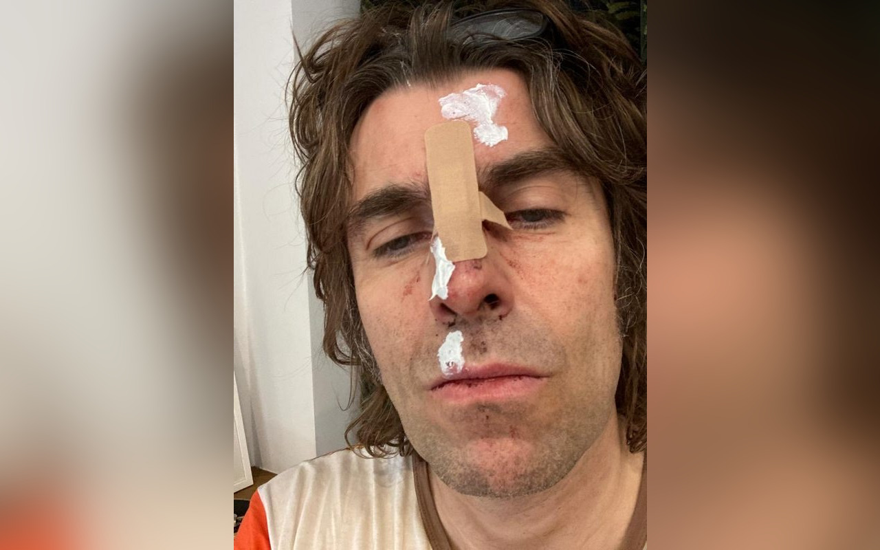 Liam Gallagher Left With Bloody Face After Falling From Helicopter