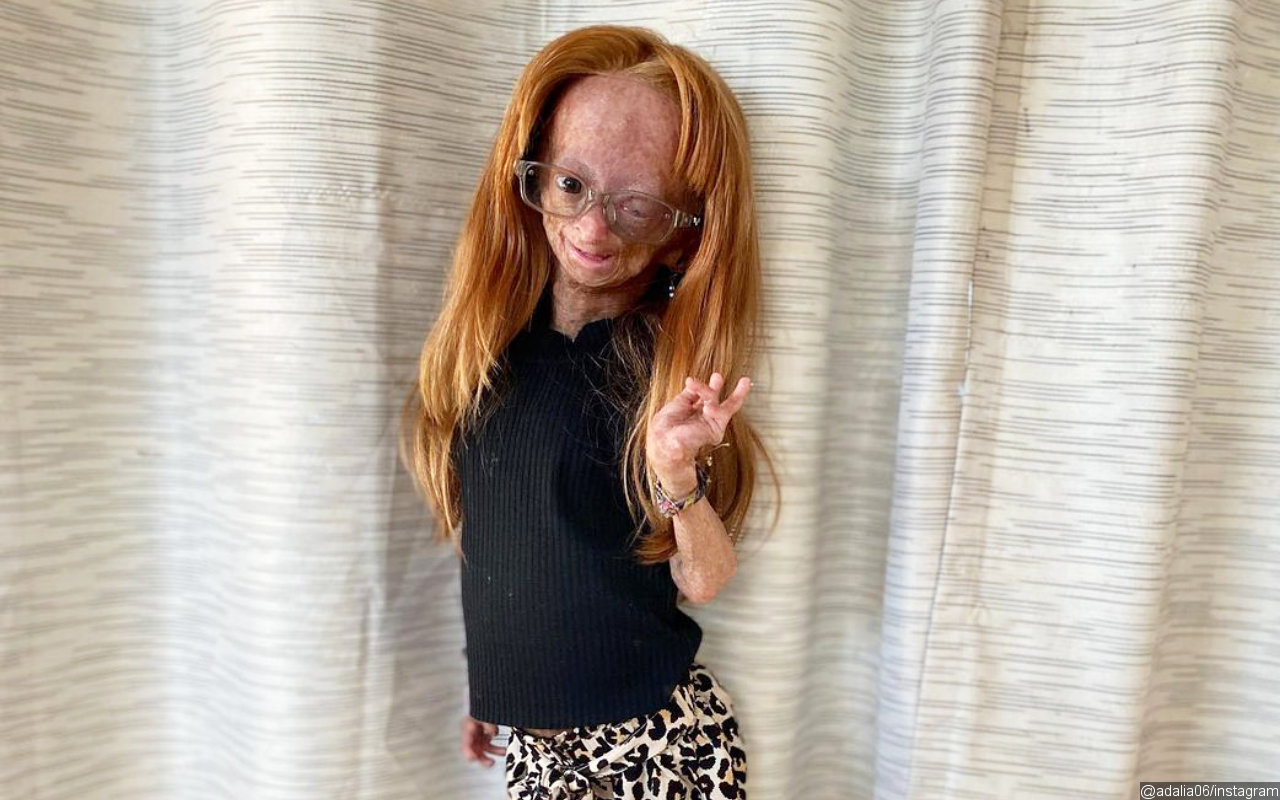 YouTube Star Adalia Rose Williams Died at Age 15 Weeks After Losing Hearing
