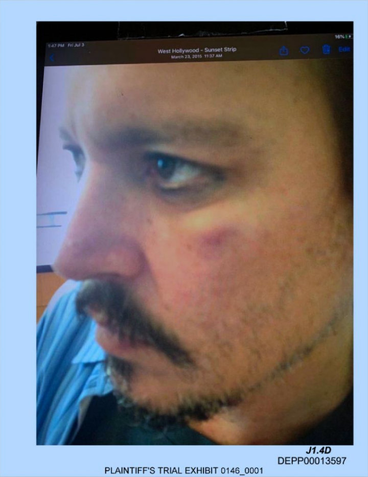 Johnny Depp's Bruised Face