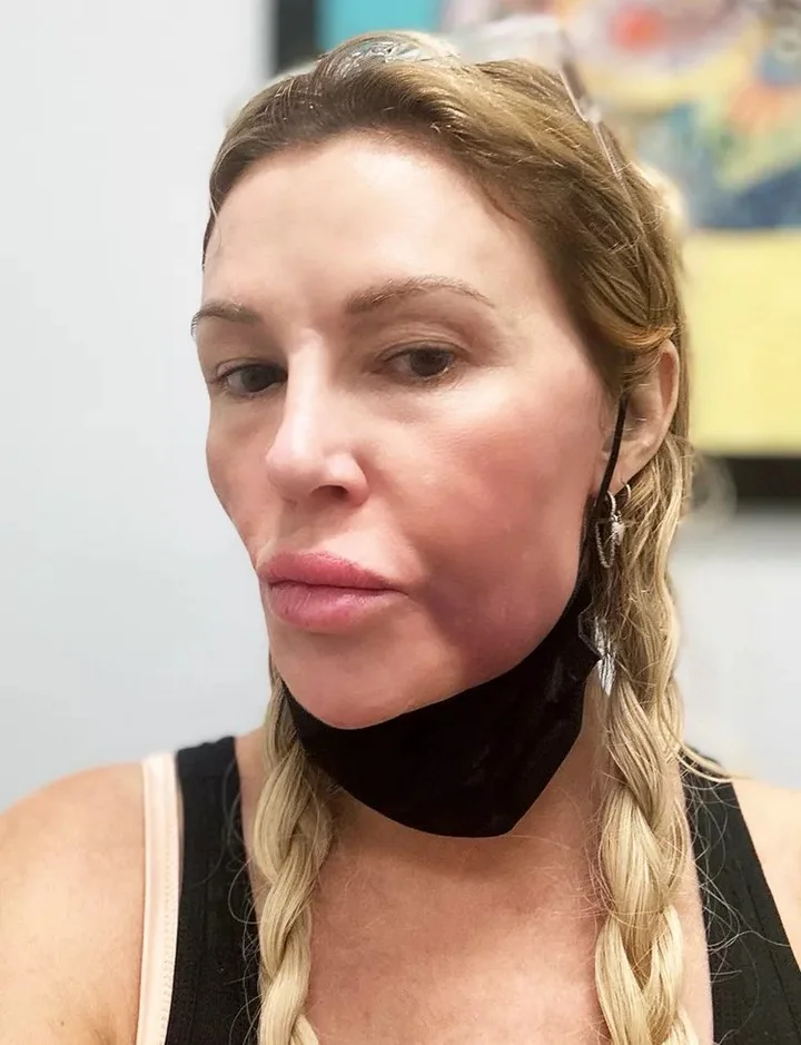 Brandi Glanville shows her face swelling amid depression