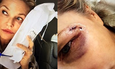 Christie Brinkley Gets Stitches and Black Eye for Trying to Save a Bird