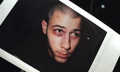 Nick Jonas Sports Black Eyes in Picture Shared by Brother Joe