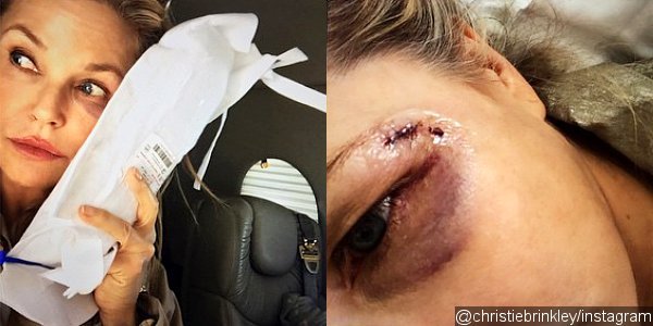 Christie Brinkley Gets Stitches and Black Eye for Trying to Save a Bird